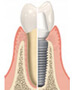 Dental Implant