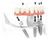 Dental Implant